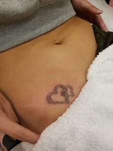 woman hip with two hearts laser removal